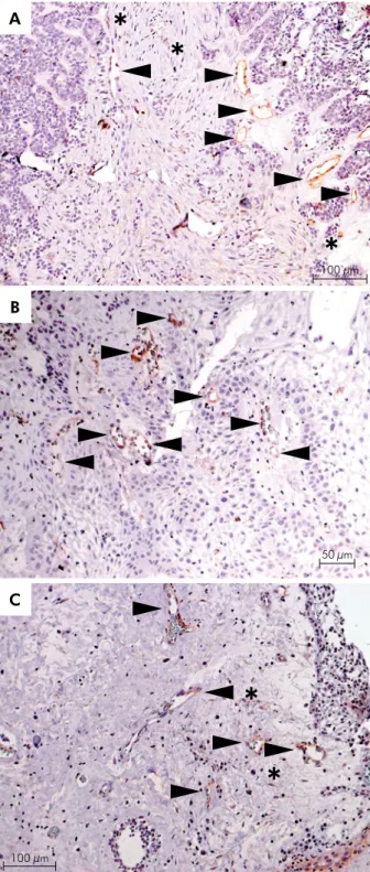 Table 2.  Diferences in CD90 expression in multicystic and  unicystic ameloblastomas.*