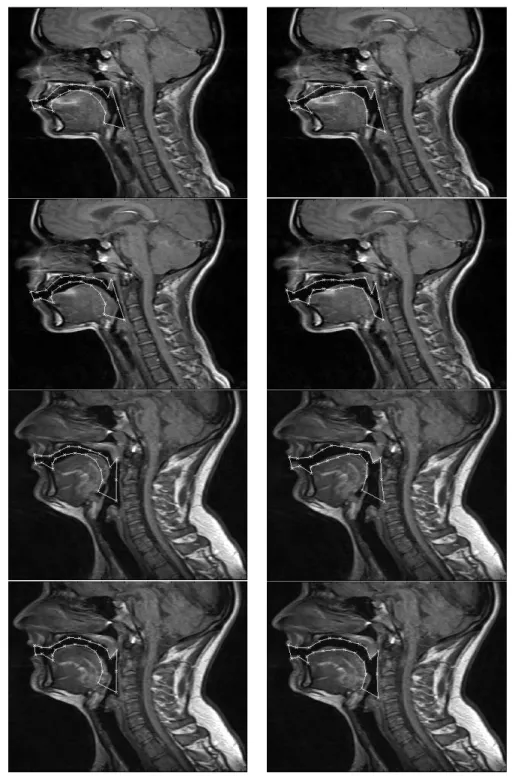 Figure 3.17  – Four test images overlapped with the mean shape model built (left)  and after the  conclusion of the segmentation process by the active shape model built (right)