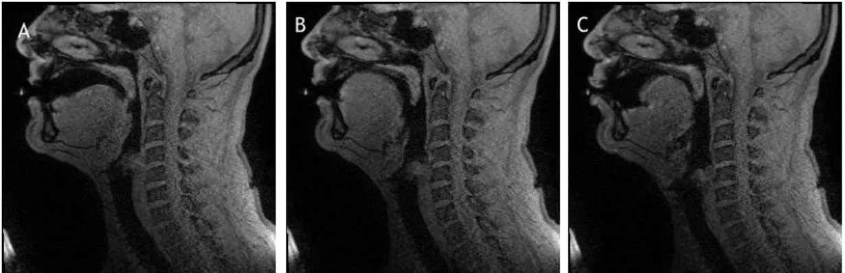 Figure 10 - Examples of images from the 3.0T image dataset used, of imaging of the oral sounds a  (A), i (B) and u (C).