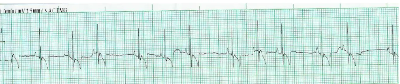 Figura  3: ECG na  derivação  II  (25  mm/). Arritmia  sinusal respiratória.  Original