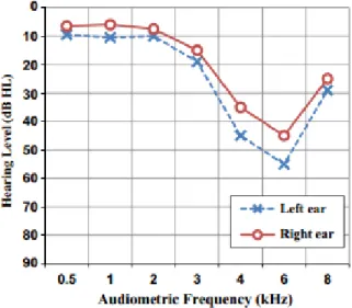 Figura 2: Padrão audiométrico típico da perda auditiva induzida pelo ruído 10 . 
