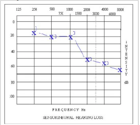 Figura  3  |  Audiograma  demonstrativo  de  um  desvio  do  limiar  auditivo para as frequências 2000-8000 Hz de cerca de 30 dB 9