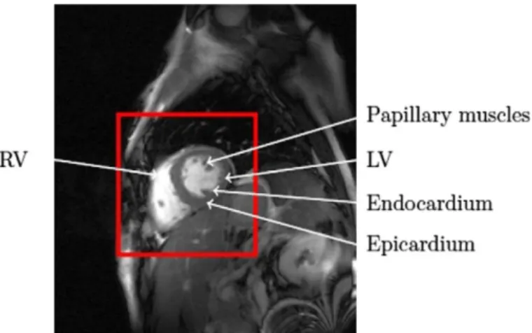 Figure 2.7 - A full size SAX CMR image and a ROI identifying the heart (from (Petitjean &amp; Dacher 2011))