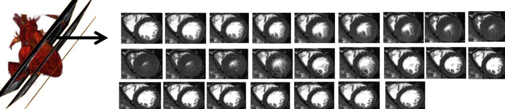 Figure 5.1.2 – Example of a cine-SAX MRI sequence from a mid-heart slice, capturing 25 instants of the cardiac cycle