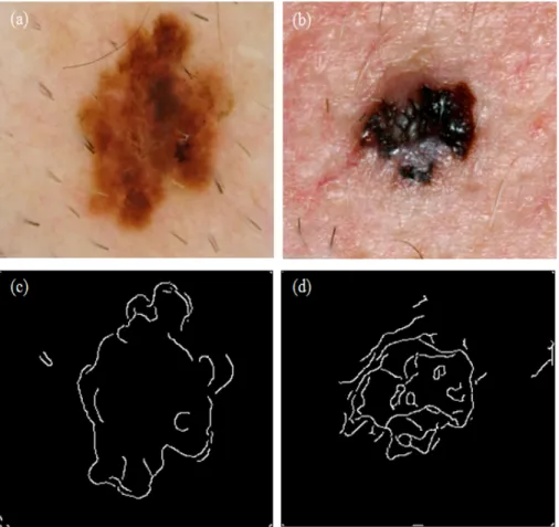 Figure 4 - Segmentation results after applying Canny’s edge detector to a dermoscopy image (a and  c), and to a macroscopic image (b and d)