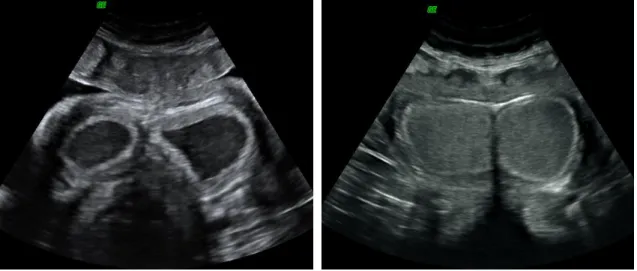 Figure 25: Ultrasound images of the left and right ampullae showing different densities; image on the  right  presents  higher  spermatozoa  concentration  (can  concentrate  over  1  billion  sperm  cells  per  millilitre)  (Courtesy  of  Dr  Thomas  Hild