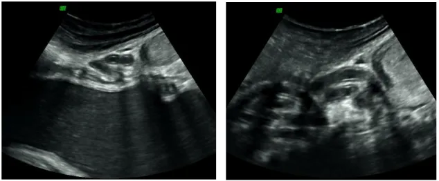 Figure  30:  Ultrasound  image  of  the  ductus  deferens  with  visible  lumen  (Courtesy  of  Dr  Thomas  Hildebrandt, Department of Reproduction Management – IZW, Germany).
