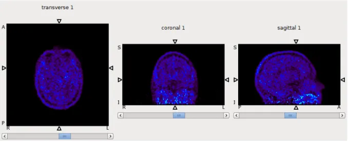 Figure 6.1: 18 FET-PET images for a negative tumor patient. No active region is shown.