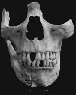 Fig.  19 – Conexão  anatómica  de  uma  calote  craniana e mandíbula (PF. 1).