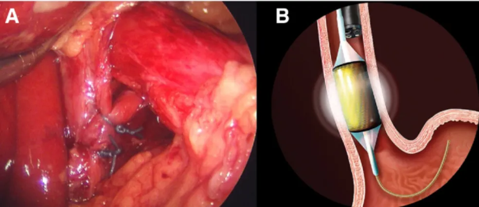Figure 2. (A) Extensive type II mediastinal dissection allows straightening of the distal esoph- esoph-agus and the gastroesophageal junction rests within the abdomen