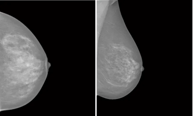 Figure 1.1: Example of a CC view (left) and MLO view (right) of a breast (selected from the HSJ database).