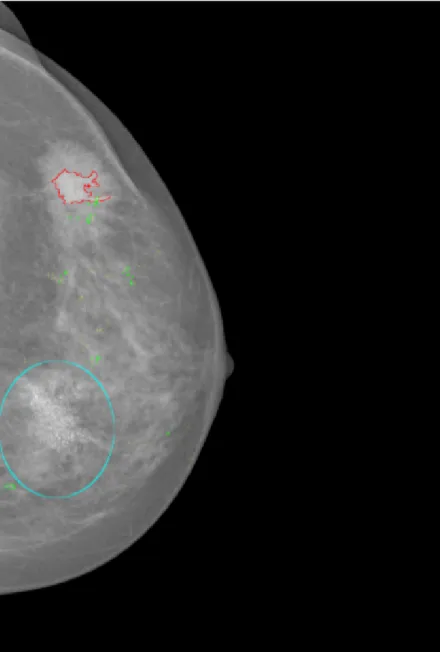 Figure 1.5: Example of a mammogram annotation of the HSJ database. Masses are in red, small microcalcifications in yellow, large microcalcifications in green, and clusters of microcalcifications in blue.