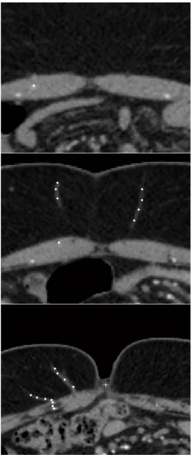 Figure 4.5: Slices with example perforator annotations shown as white circles and umbilicus po- po-sition marked with a white asterisk.