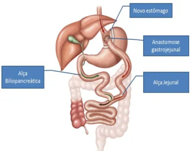 Figura 2-1. Gastroplastia redutora em Y-de-Roux 