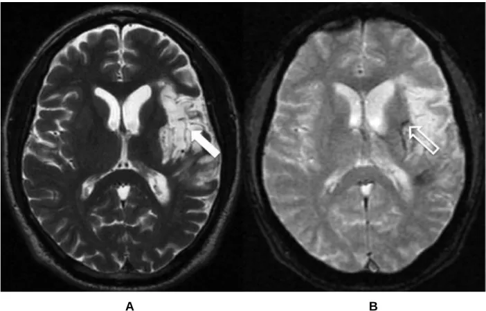 Figura 1- Imagens de ressonância magnética no plano axial (A - ponderada em T2 e B  - gradiente refocalizado eco) de um paciente masculino de 55 anos, onde se observa  uma  área  de  malácia  secundária  à  isquemia  (seta)  com  sinais  de  transformação 