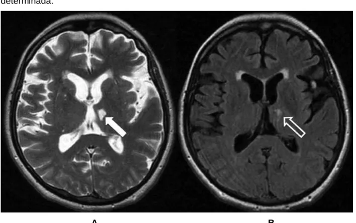 Figura 2 – Imagens de ressonância magnética no plano axial (A – ponderado em T2 e  B – fluid atenuated inversion recovery – FLAIR), de paciente feminino de 62 anos, com  diminuta  área  de  malácia  no  tálamo  esquerdo  (seta),  circundado  por  gliose  (