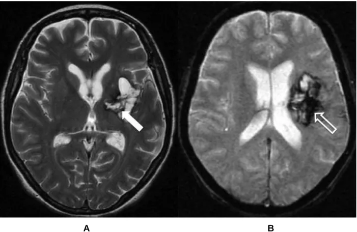 Figura 3 – Imagens de ressonância magnética no plano axial (A – ponderada em T2 e  B  gradiente  refocalizado  eco)  de  paciente  feminino  de  48  anos  com  área  de  malácia  (seta)  preenchida  por  produtos  de  degradação  da  hemoglobina  –  ferrit