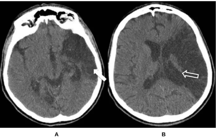 Figura  4  –  Imagens  de  tomografia  computadorizada  no  plano  axial,  de  paciente  masculino de 51 anos, com áreas de malácia (seta fechada) por  isquemia no território 