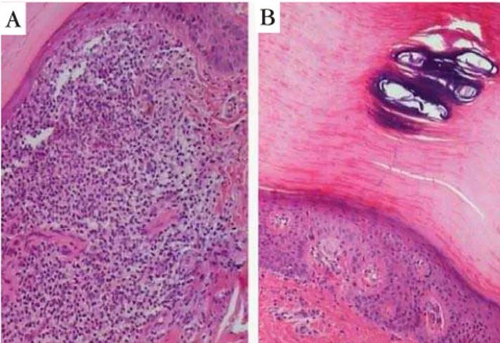 Figura 2: Exame anatomopatológico - Microscopia óptica - A. Hiperqueratose, atrofia epidérmica, denso infiltrado inflamatório em banda na derme papilar com linfócitos e alguns histiócitos nas lesões novas (hematoxilina e eosina - HE, 100x)