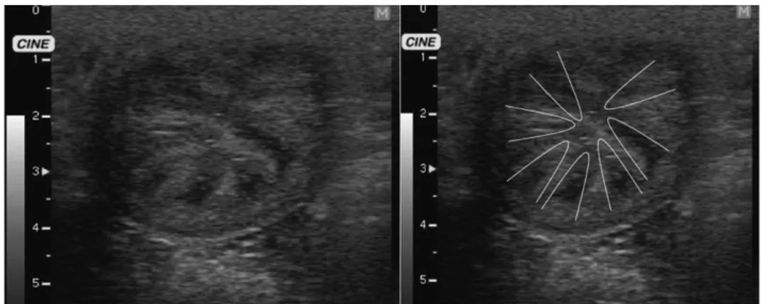 Figura 11 – Edema uterino grau 3. É nítido o padrão em “gomos de laranja” ao longo de todo  o útero
