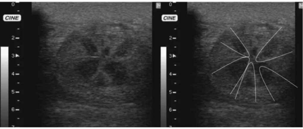 Figura  12  –  Edema  uterino  grau  4.  Pregas  endometriais  proeminentes  e  mais  espessas  possuindo um bordo hiperecogénico (Samper, 2009) 