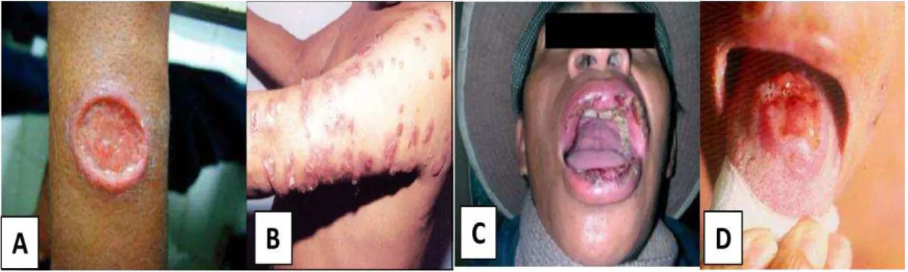 Figura 3  –  Formas clínicas das leishmanioses. A: cutânea localizada; B: cutânea difusa; C:mucocutânea; D: 