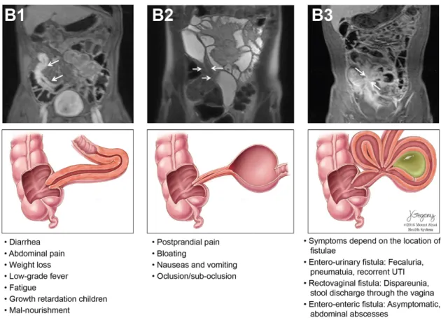 Figure 1 – Crohn´s disease classification based on disease behaviour. The figure depicts the three  types  of  behaviour  of  Crohn´s  disease  as  per  the  Montreal  classification  represented  in  magnetic  resonance enterography (MRE) and illustrated,