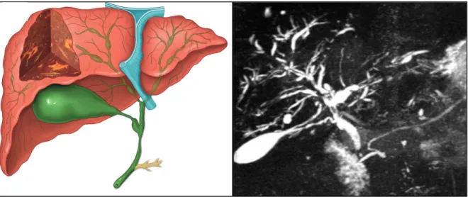 Figure  4  –  Typical  findings  of  Primary  Sclerosing  Cholangitis.  Diagram  (left)  and  magnetic  resonance  cholangiopancreatography  imaging  (right)  showing  the  typical  findings  of  primary  sclerosing cholangitis