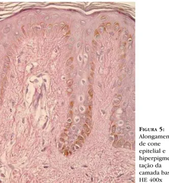 FIGURA 5: Alongamento de cone epitelial e  hiperpigmen-tação da  camada basal -  HE 400x