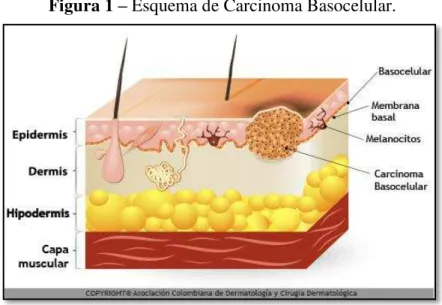 Figura 1  –  Esquema de Carcinoma Basocelular.
