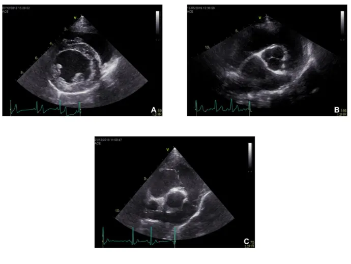 Figure 2.  Right parasternal short axis left ventricle view at the level of the papillary muscles  (A),  heart  base  aorta  and  left  atrium  view  (B)  and  heart  base  pulmonary  artery  view  (C)