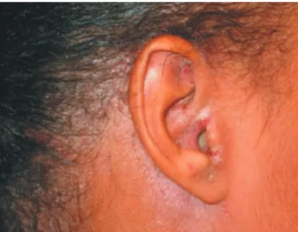 Figura 2: Dermatite seborréica: eritema e descamação – detalhe do dorso em indivíduo soropositivo assintomático