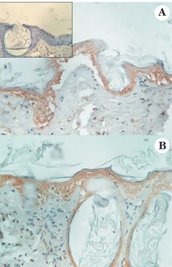 FIGURA 1: Necrose degenerativa da epiderme na pele do camundongo após terapia fotodinâmica com ftalocianina de