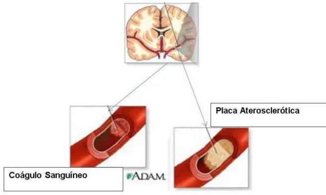 Figura 1. Mecanismos Fisiopatológicos do AVC isquêmico 