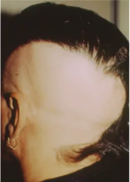 FIGURA 3: Alopecia areata multifocal FIGURA 4: Alopecia areata ofiásica
