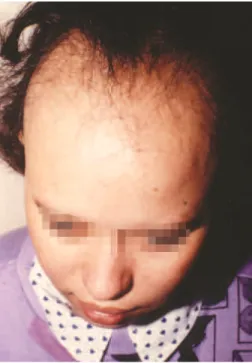 FIGURA 5: Alopecia areata total FIGURA 6: Alopecia areatatipo sisaifo