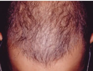 FIGURA 8: Alopecia areata difusa