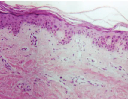 FIGURA 1: Hiperpigmentação reticulada na região lombossacra