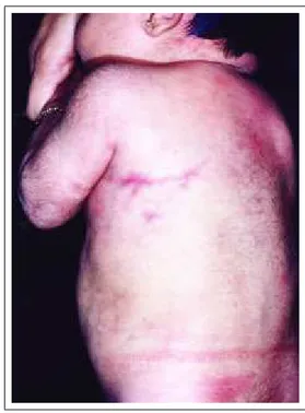 Figure 3:  Congenital  telangiectatic  cutis marmorata.Figura 3: Cútis marmórea telangiectásica congênita.