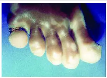 Figura 1: Presença de anel fibroso ao redor do quinto dedo do pé direito, com edema e supuração local