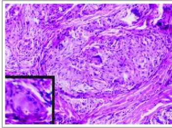 Figura 3: Granuloma de  células epiteliais sem halo linfocitário com gigantócitos do tipo Langhans (HE x 200), no detalhe corpúsculo  aster-óide (HE x 400).