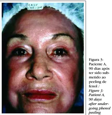 Figura 3: Paciente A, 90 dias após ter sido  sub-metido ao peeling de fenol / Figure 3: Patient A,  90 days after  under-going phenol peeling