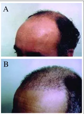 Figure 2a - Hamilton  type VII patient