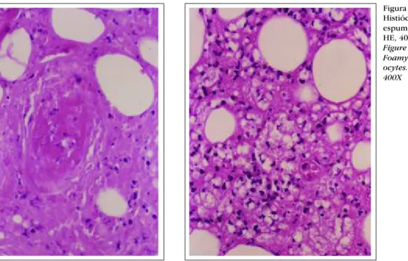 Figura 4: Vasculite  leucocito-clásica. HE, 400X Figure 4: Leukocytocl astic  vas-culitis