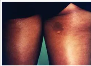 Figura 1:  Fenômeno halo  ocorrendo sobre o  componente juncional  de um nevo  spilus Figure 1:  Halo phenomenonoccurring  on the  junctional component  of a nevus spilus