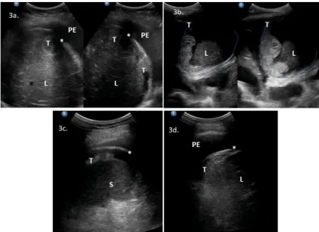 Figure  3.  Intercostal  upper  abdomen  ultrasonograms  of  lesions  on  the  abdominal  diaphragmatic  surface:  (3a)  bulky tumors  between the  liver  and  diaphragm;  (3b)  solid-cystic tumors between the Figure 2