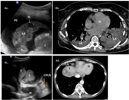 Figure 4. Lung ultrasonography and chest computed tomography (CT) of the lower parts of the pleural  space and lungs: (4a)  ultrasound presentation of lung consolidation, a sonographic air bronchogram  with  inflammation,  and  a  metastatic  parenchymal  