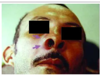 Figure 1: Patient with nasofa- nasofa-cial entomophthoromycosis showing infiltrative lesions affecting the right nasal region