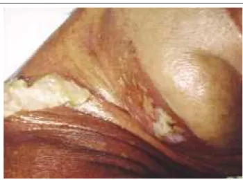 Figura 11:  Necrólise epidérmica tóxica. Áreas extensas de desnudação epidérmica que determinam a síndrome da falência cutânea aguda