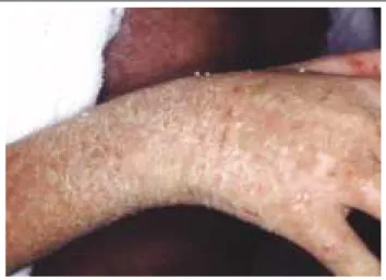 Figura 3: Dermatite esfoliativa. Eritema de base difuso e  esca-mas lamelares